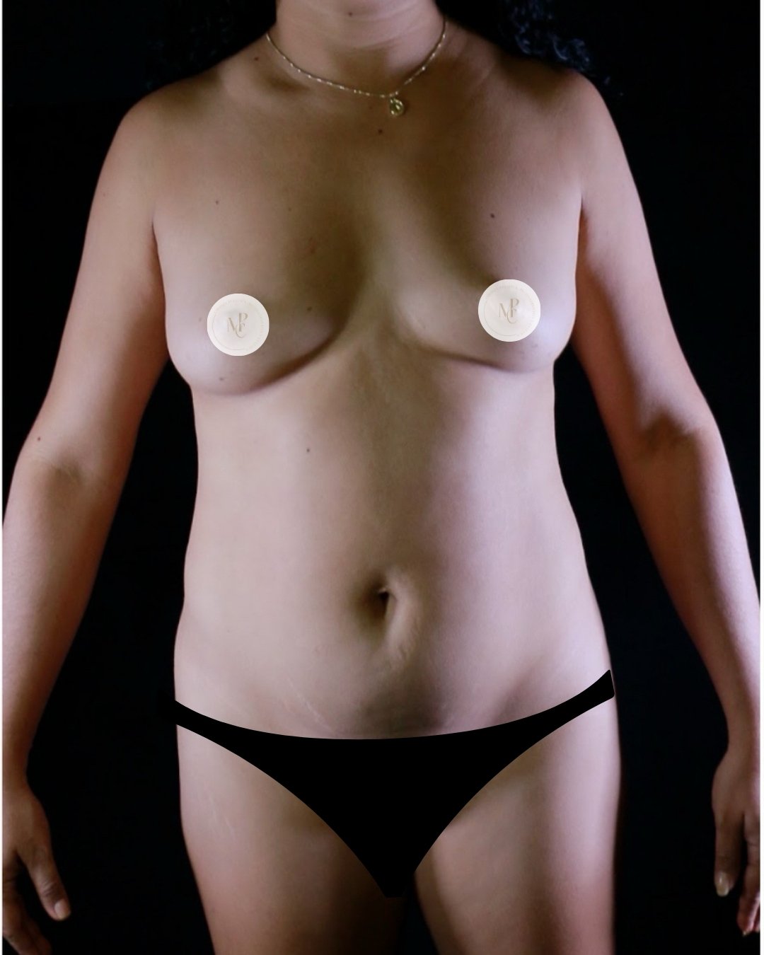 abdominoplastia-con-plicatura-01