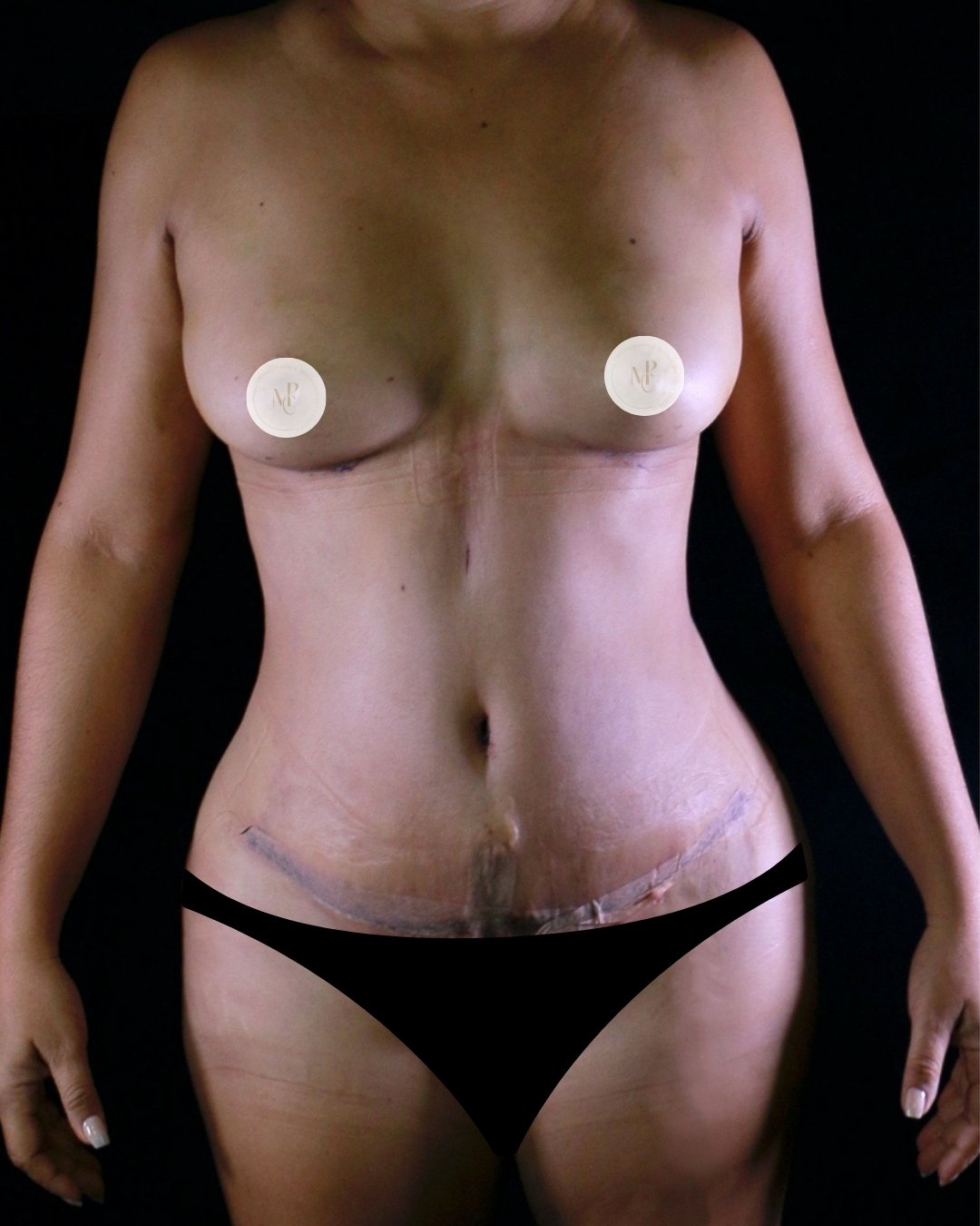abdominoplastia-con-plicatura-02