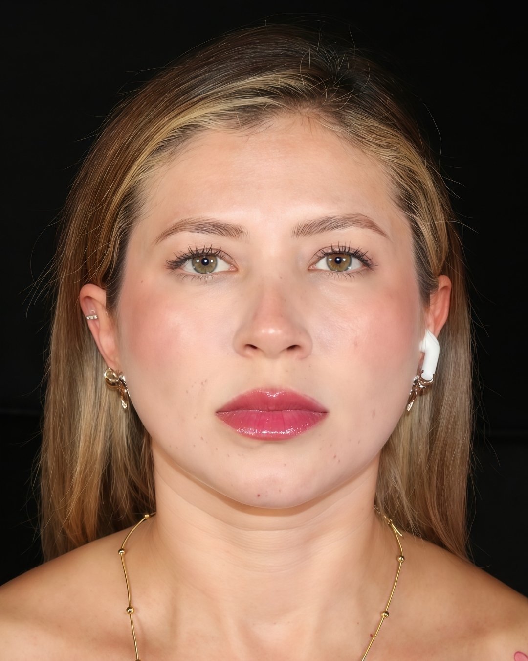 blefaroplastia-01