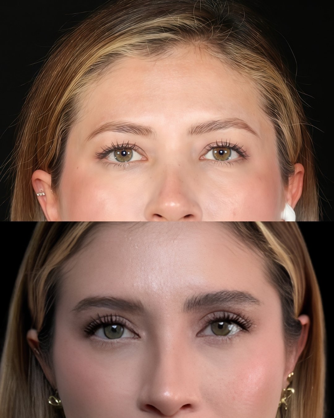 blefaroplastia-03