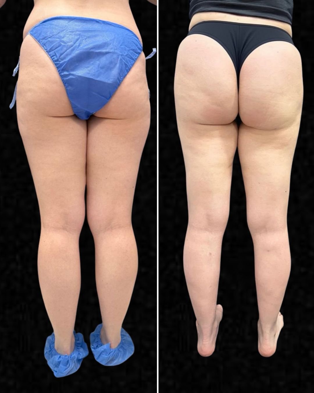 cirugia-de-lipedema-01