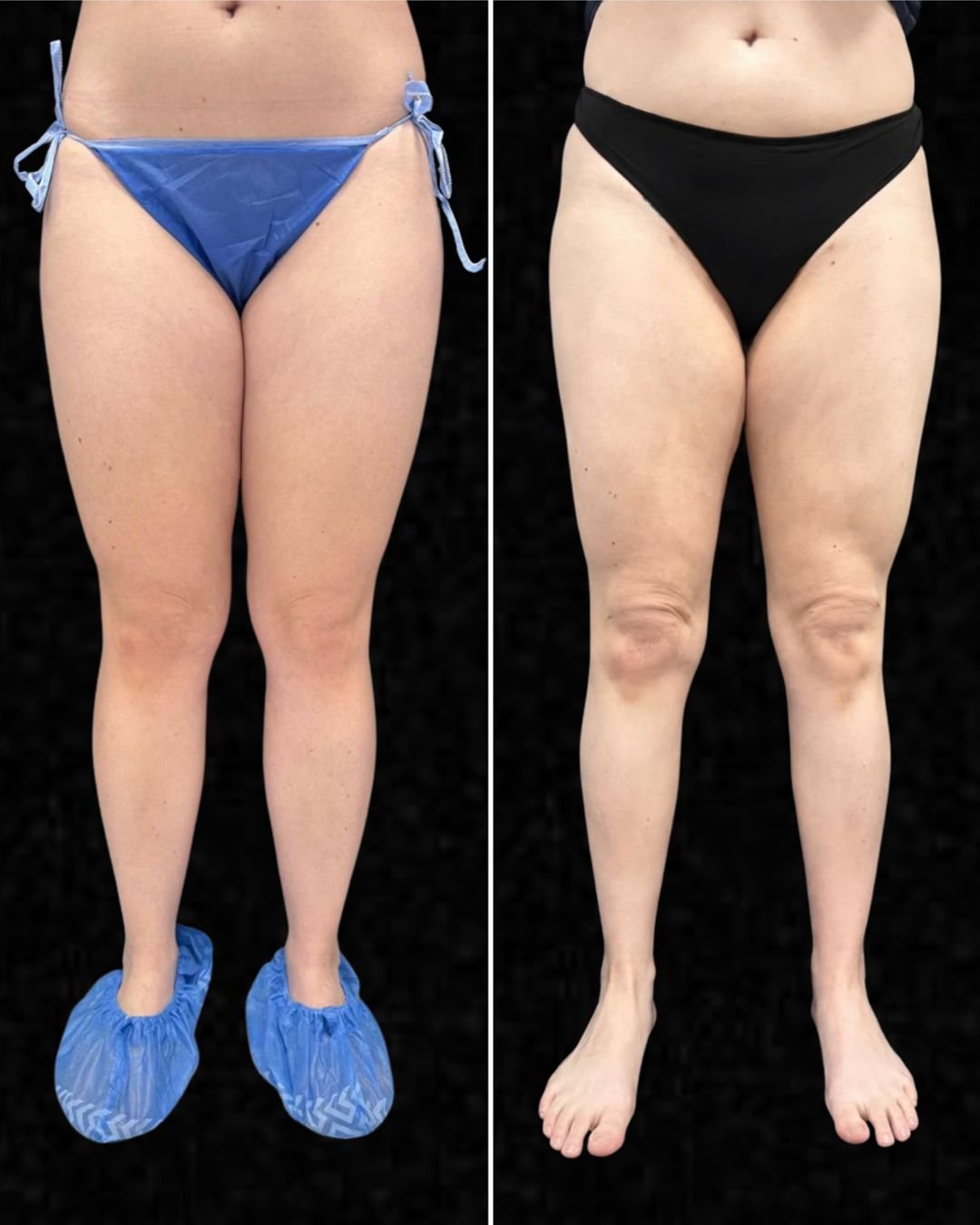 cirugia-de-lipedema-02