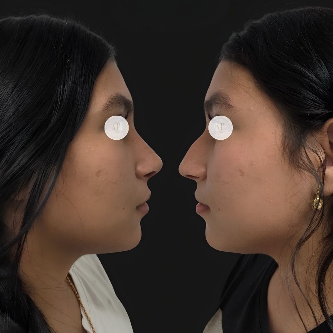 rinoplastia-estetica-y-funcional-04